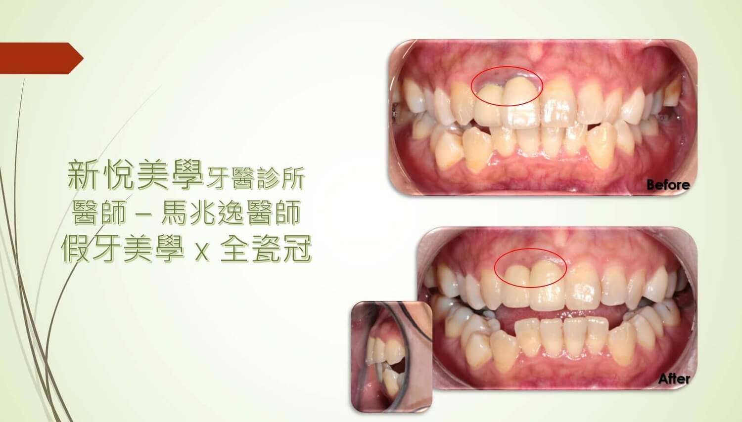新悅美學牙醫診所的案例分享圖片
