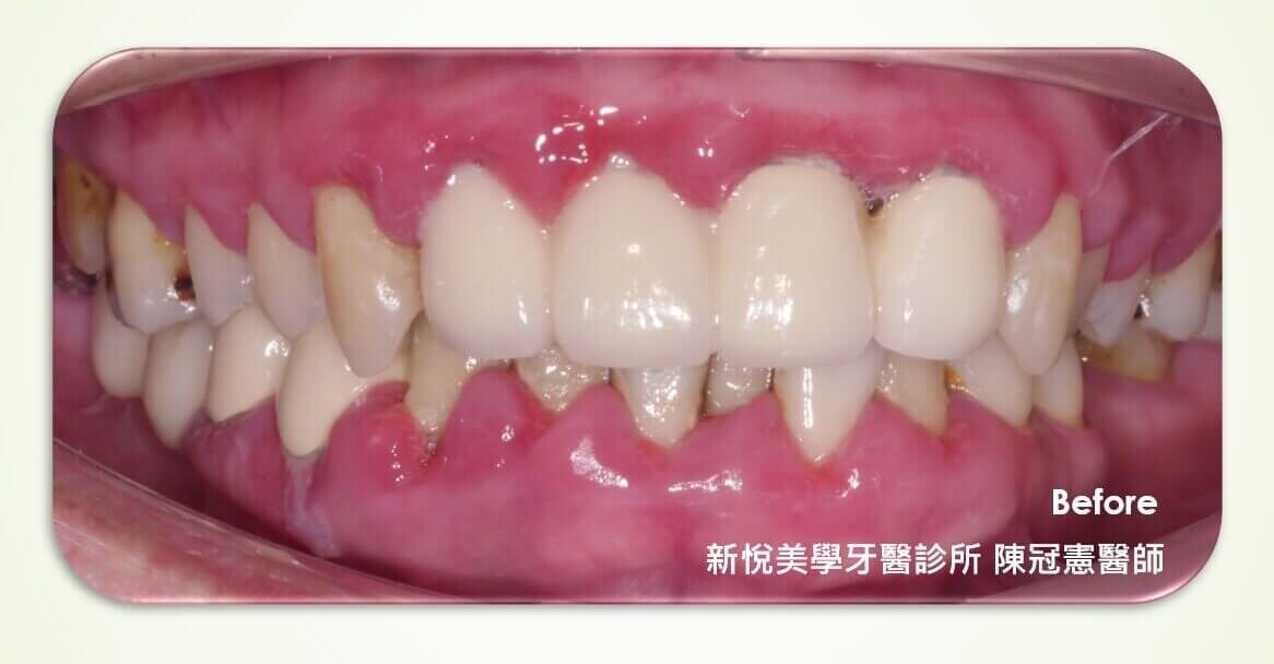 牙周病引起的口臭…的第2張圖片