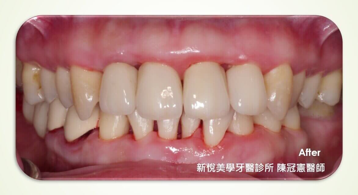 牙周病引起的口臭…的第3張圖片