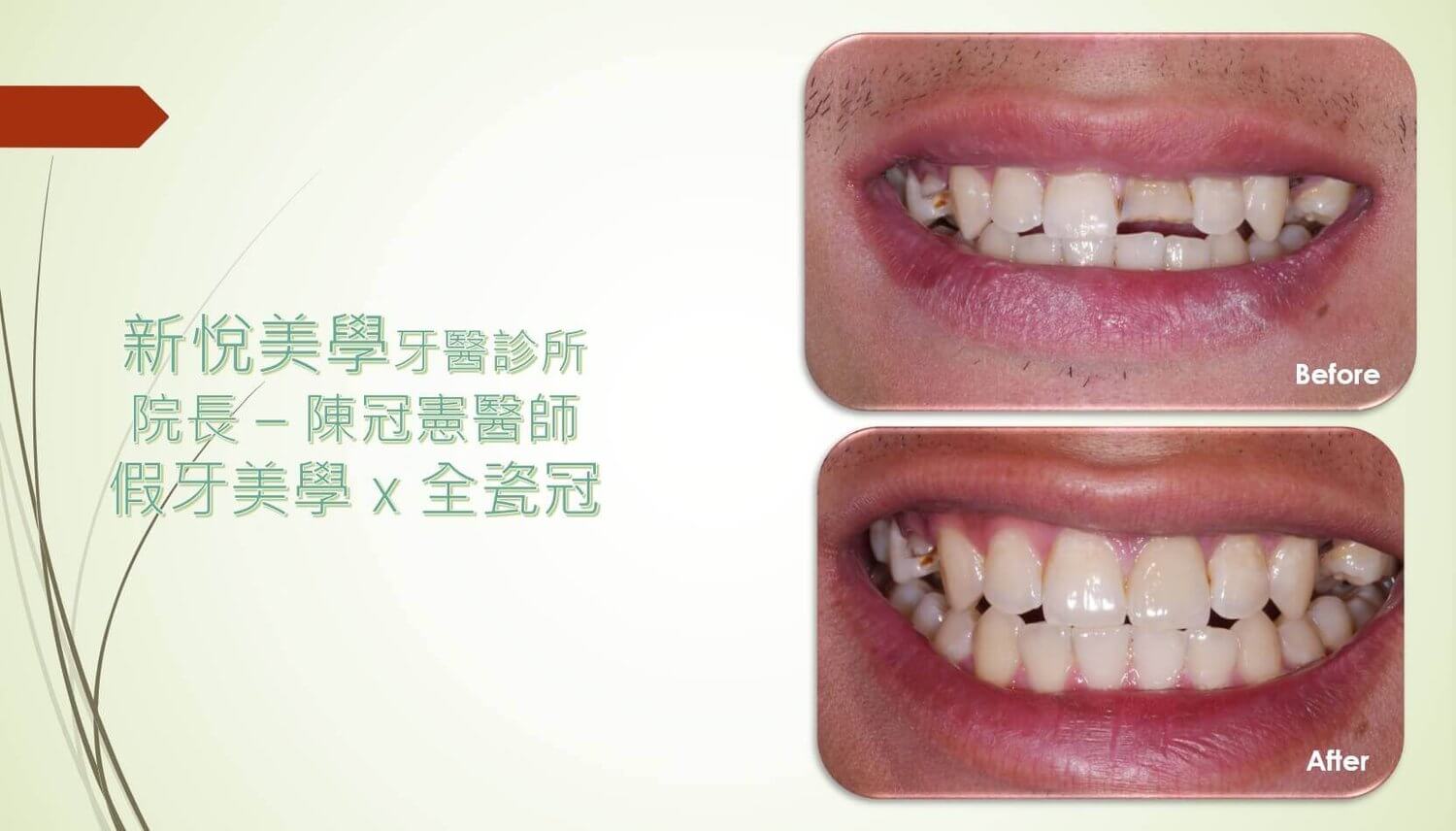 新悅美學牙醫診所的案例分享圖片