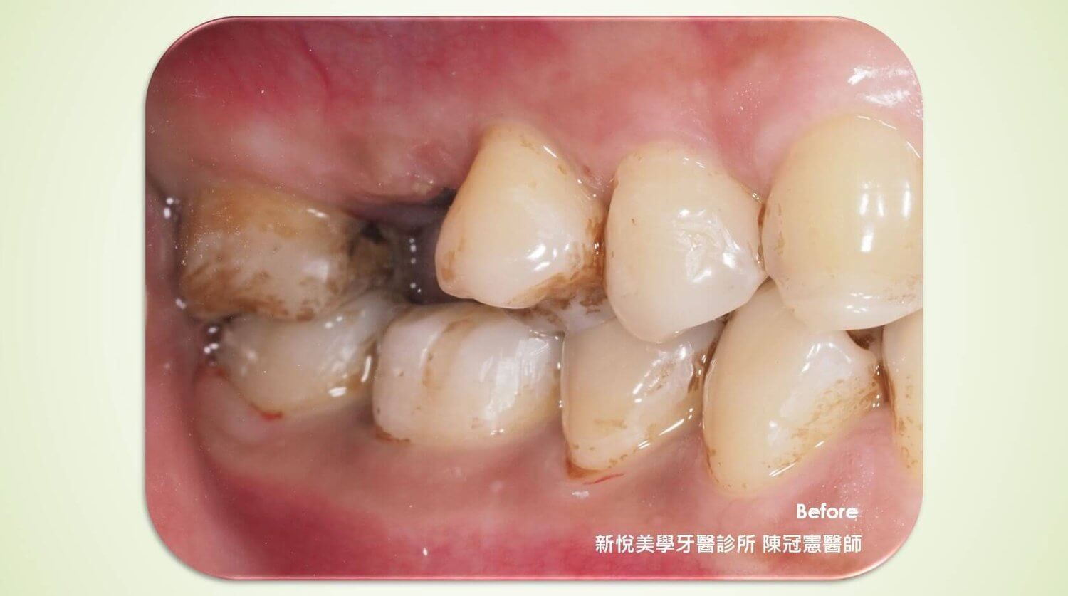 單顆缺牙為什麼都推薦植牙？的第2張圖片