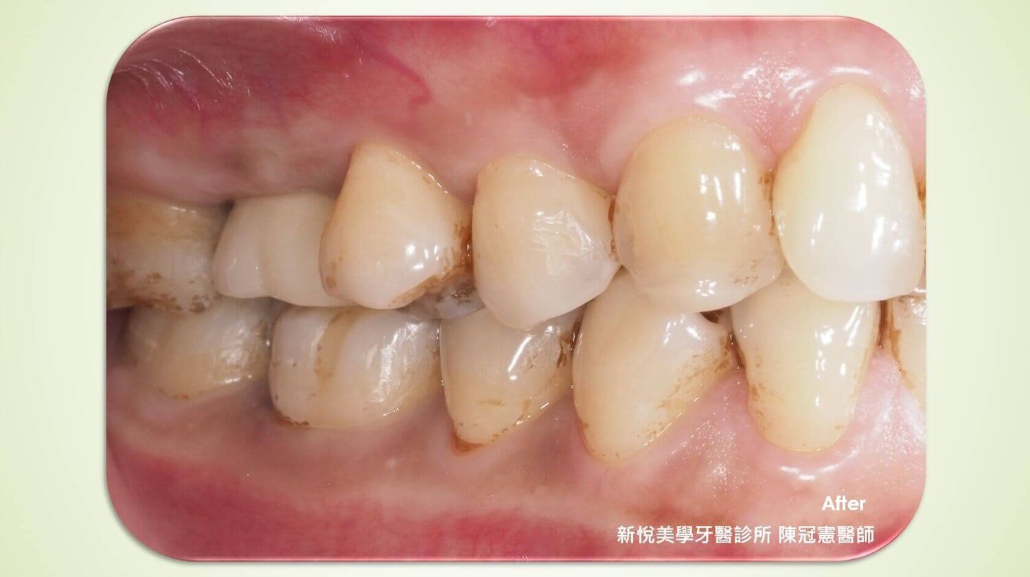單顆缺牙為什麼都推薦植牙？的第3張圖片