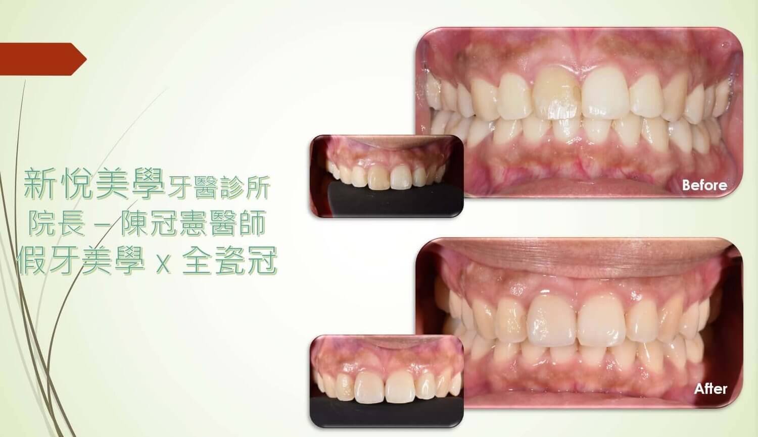 新悅美學牙醫診所的案例分享圖片