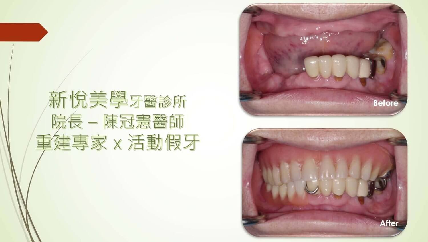 新悅美學牙醫診所的案例分享圖片