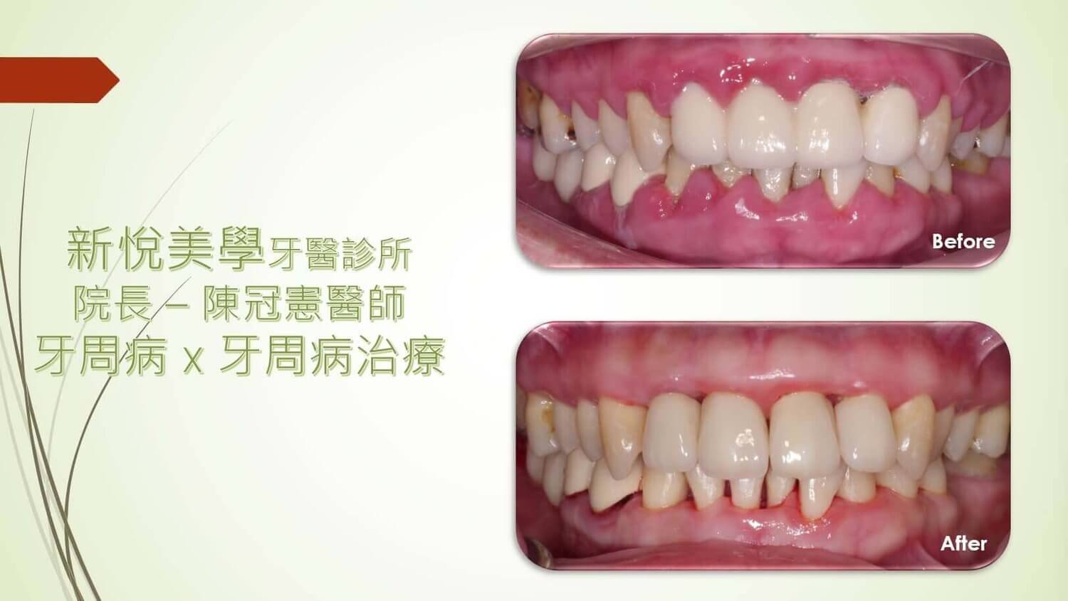 新悅美學牙醫診所的案例分享圖片