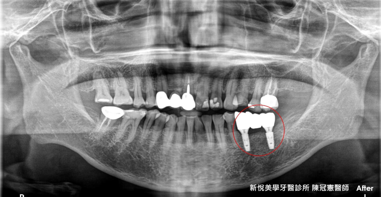 你是否口腔內也有鬆脫了又黏回去的假牙問題呢？　新悅美學牙醫診所的第4張圖片
