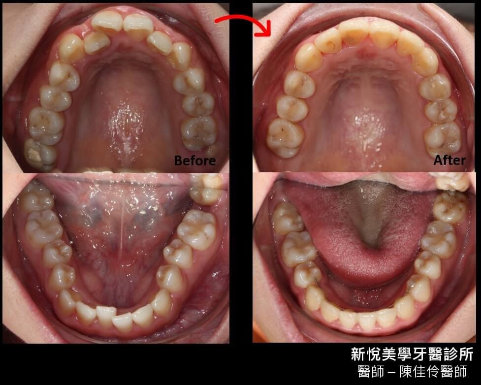 錯咬、缺牙、暴牙怎麼辦？　矯正一次解決所有問題！　新悅美學牙醫診所的第3張圖片