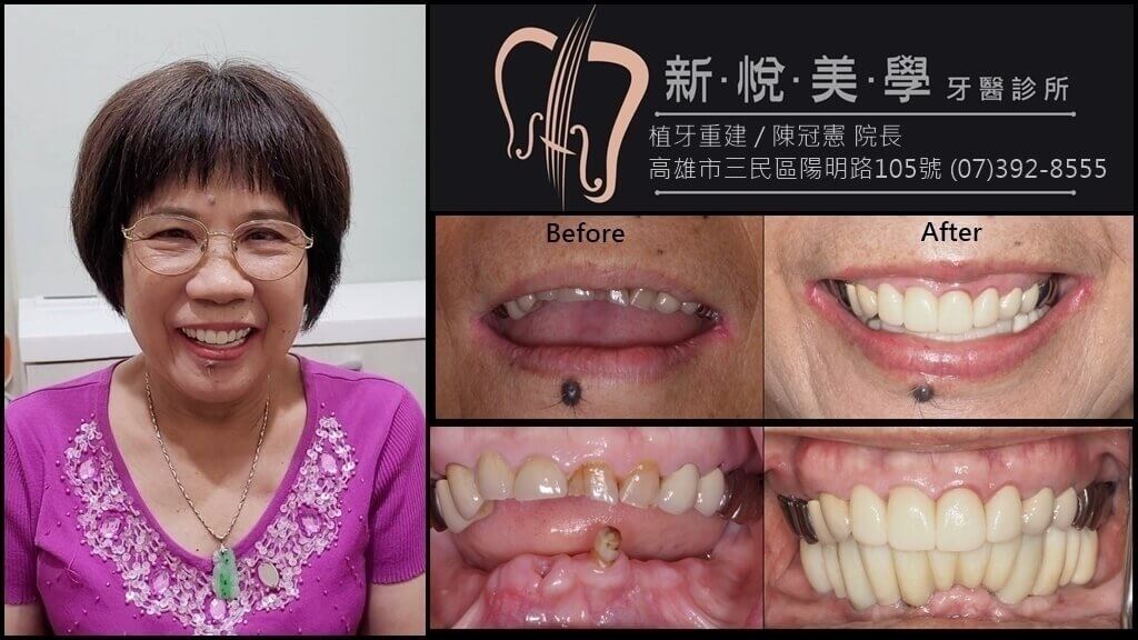 新悅美學牙醫診所的案例分享圖片