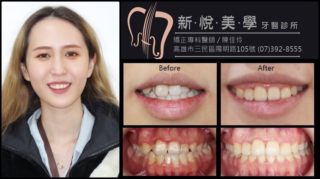 新悅美學牙醫診所的案例分享圖片