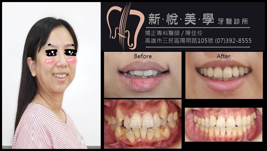 新悅美學牙醫診所的案例分享圖片