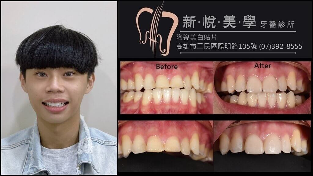 新悅美學牙醫診所的案例分享圖片