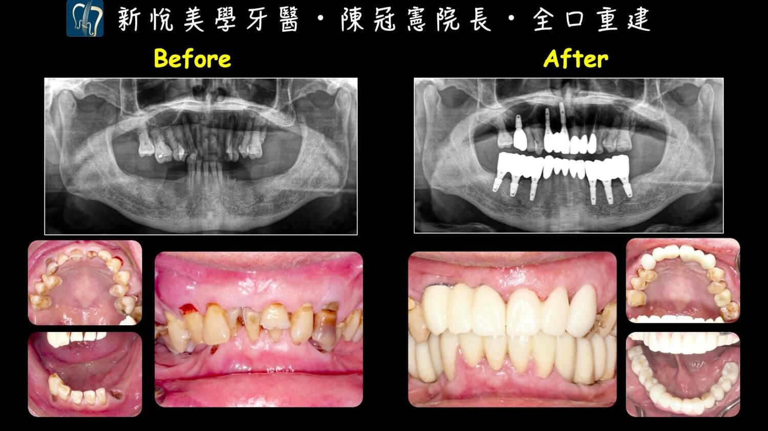 新悅美學牙醫診所的案例分享圖片