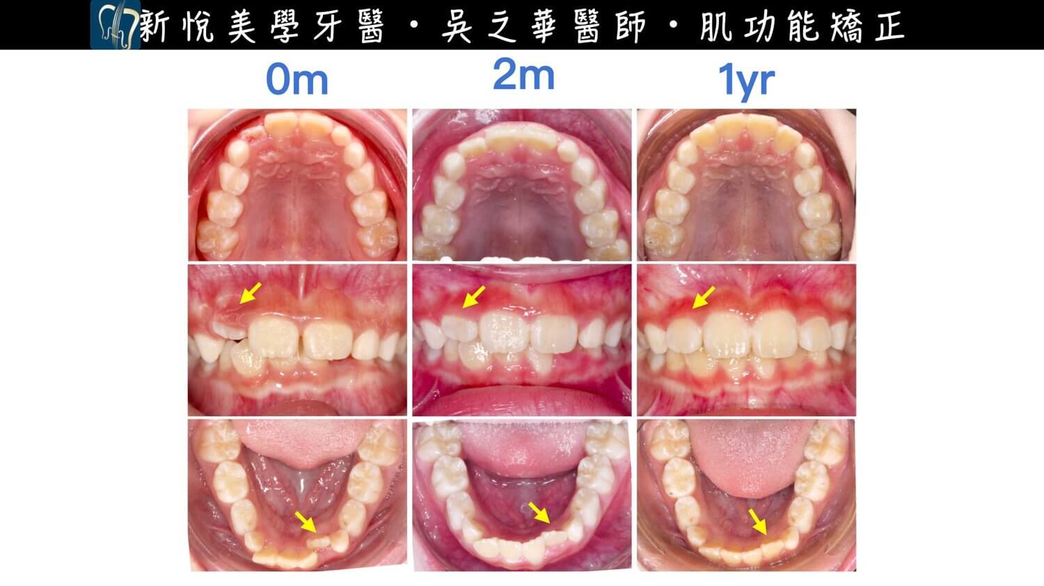 新悅美學牙醫診所的案例分享圖片