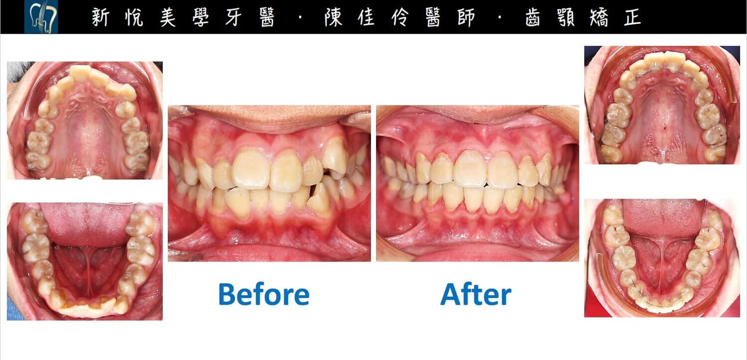 新悅美學牙醫診所的案例分享圖片