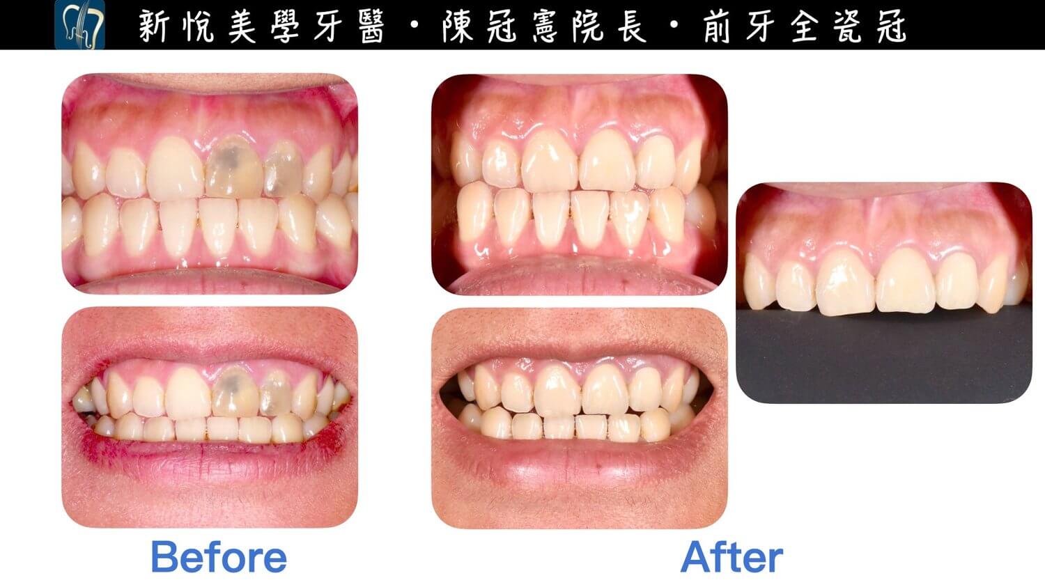 新悅美學牙醫診所的案例分享圖片