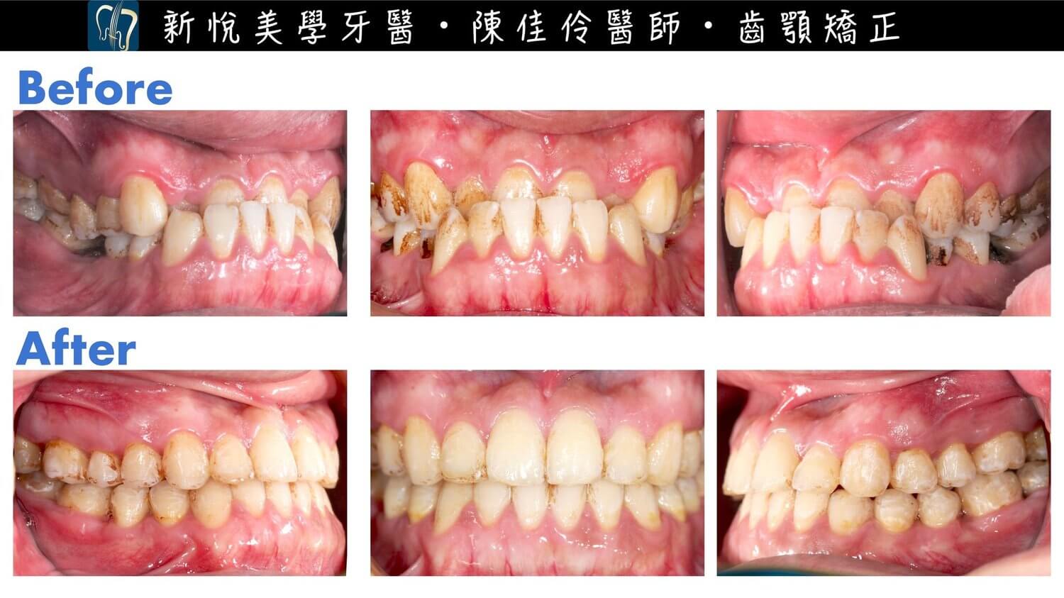 戽斗居然可以單純矯正不用正顎手術！的第2張圖片