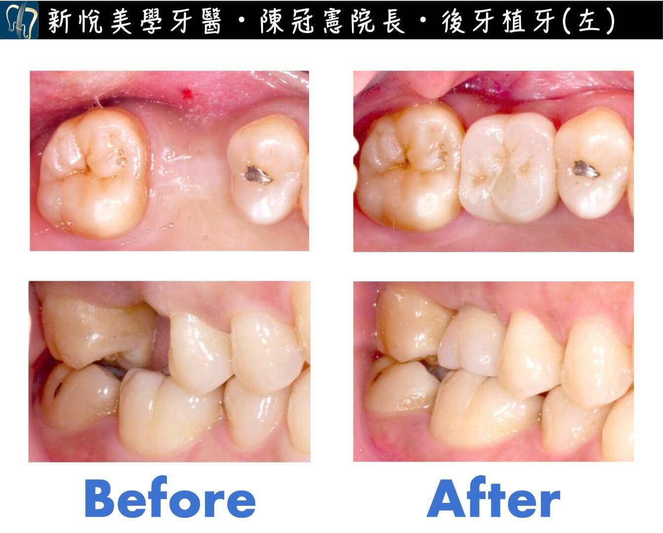 缺牙問題千萬不能拖！！！的第2張圖片