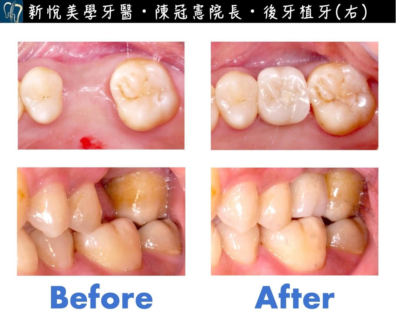 缺牙問題千萬不能拖！！！的第3張圖片