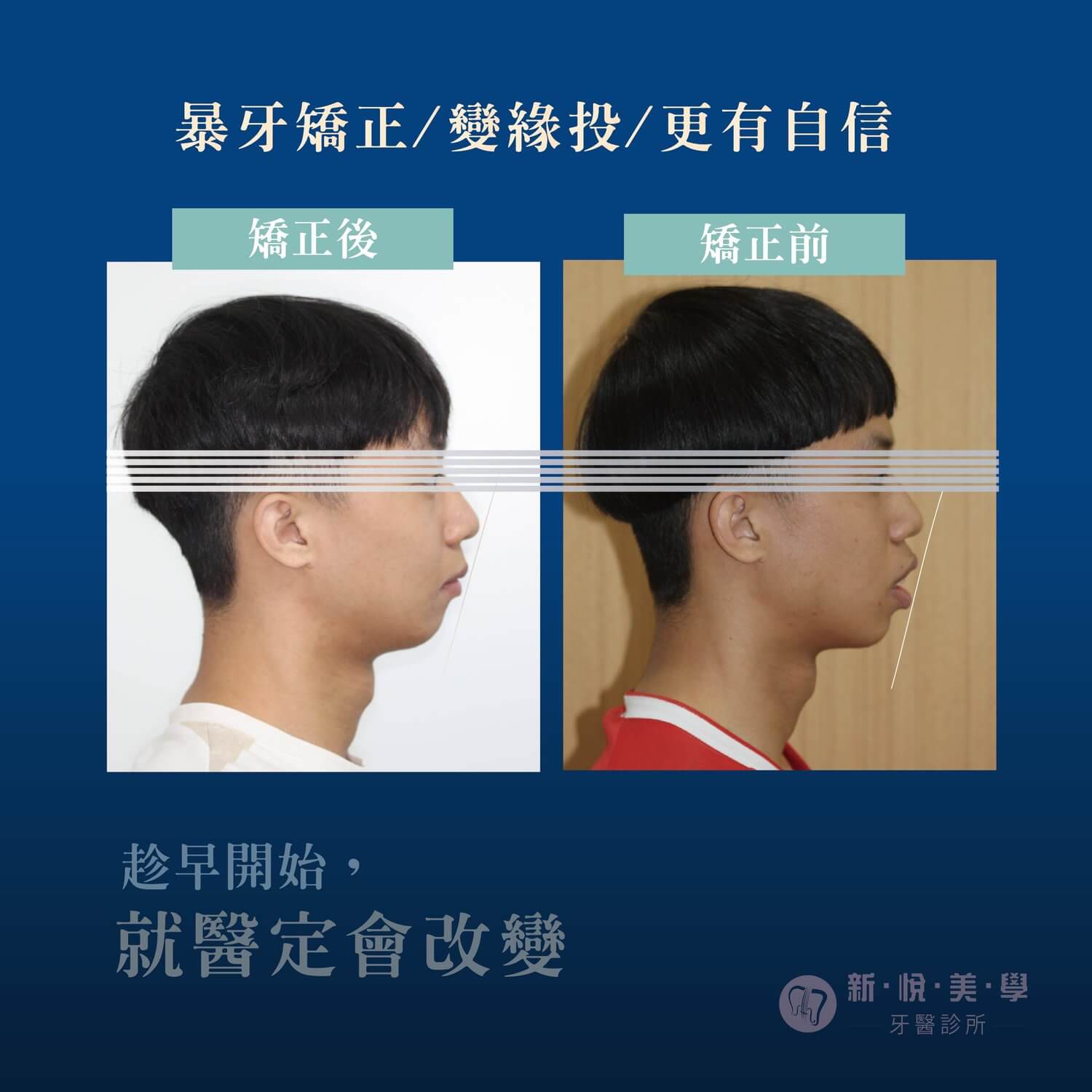 研究所口試落馬，矯正牙齒逆轉人生！的第2張圖片