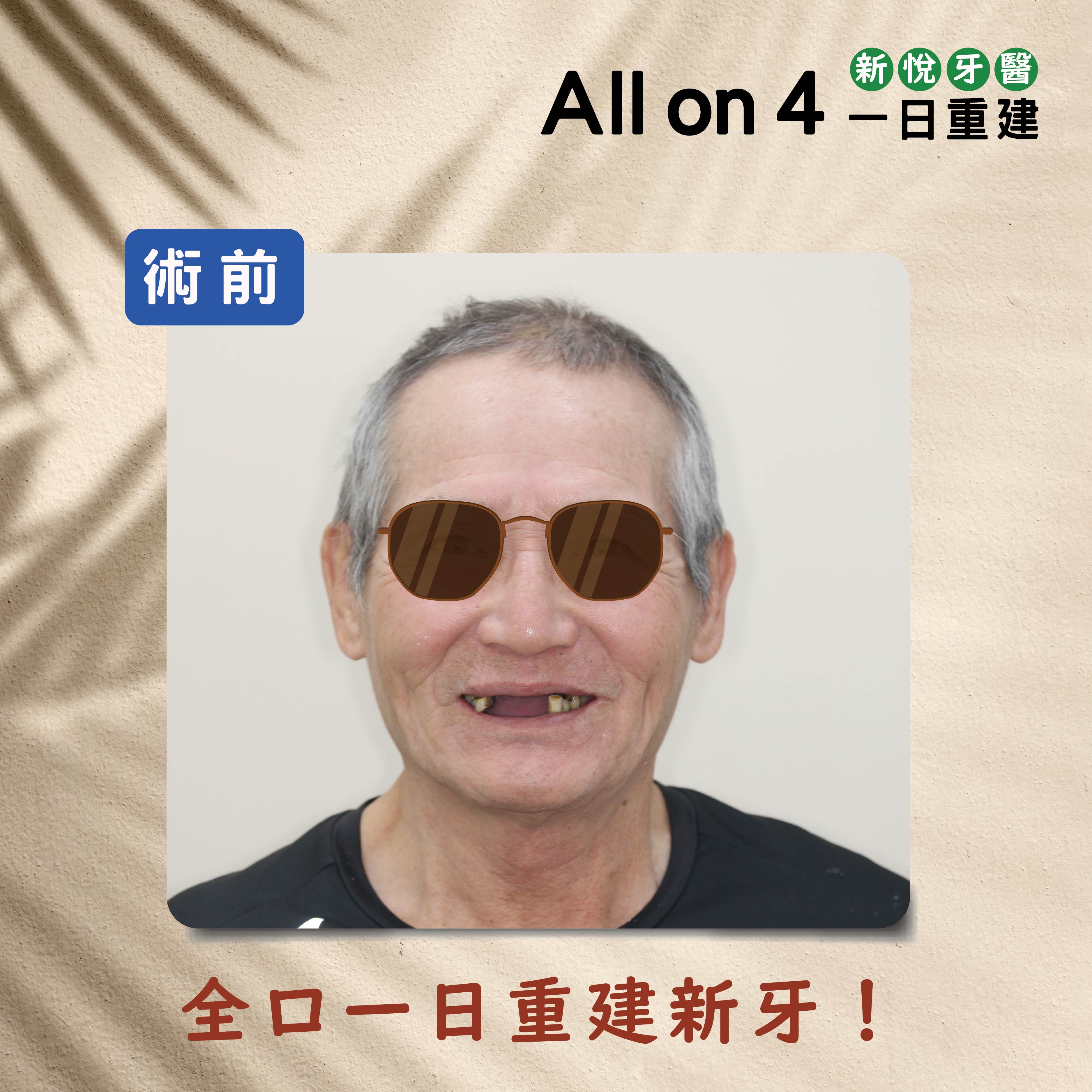 All on 4 全口重建植牙兩大專科名醫聯手接力的第5張圖片