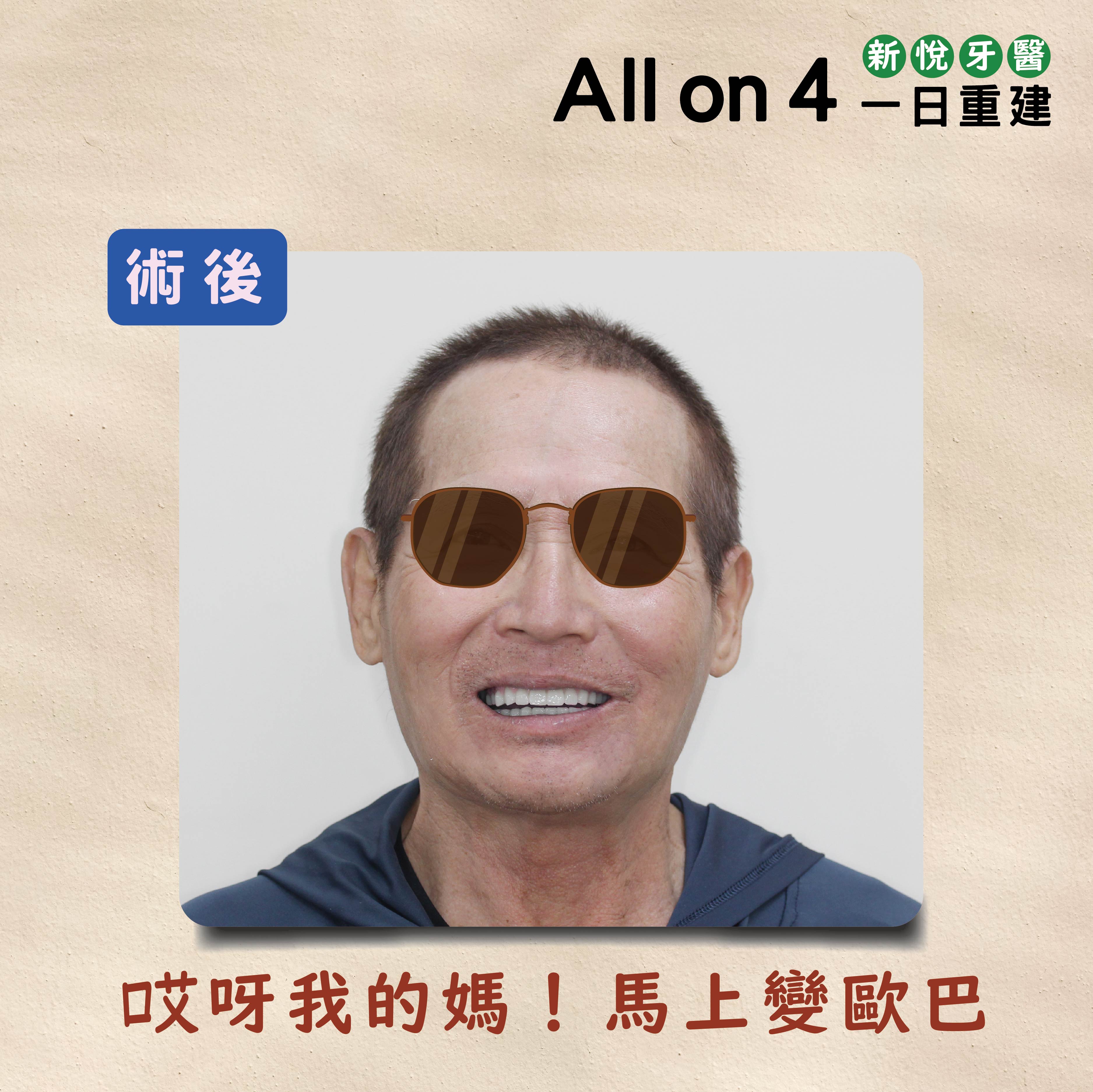All on 4 全口重建植牙兩大專科名醫聯手接力的第6張圖片