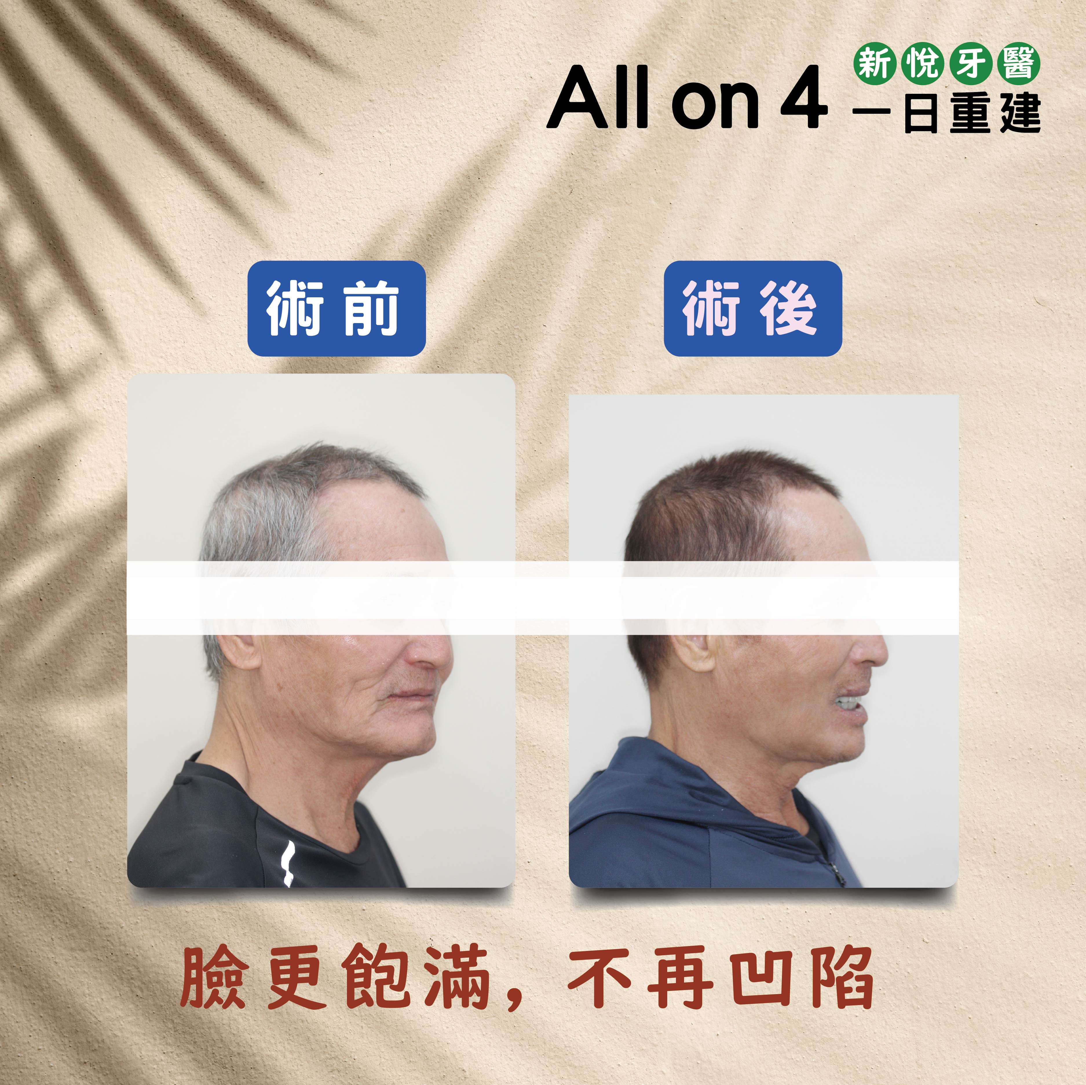 All on 4 全口重建植牙兩大專科名醫聯手接力的第7張圖片
