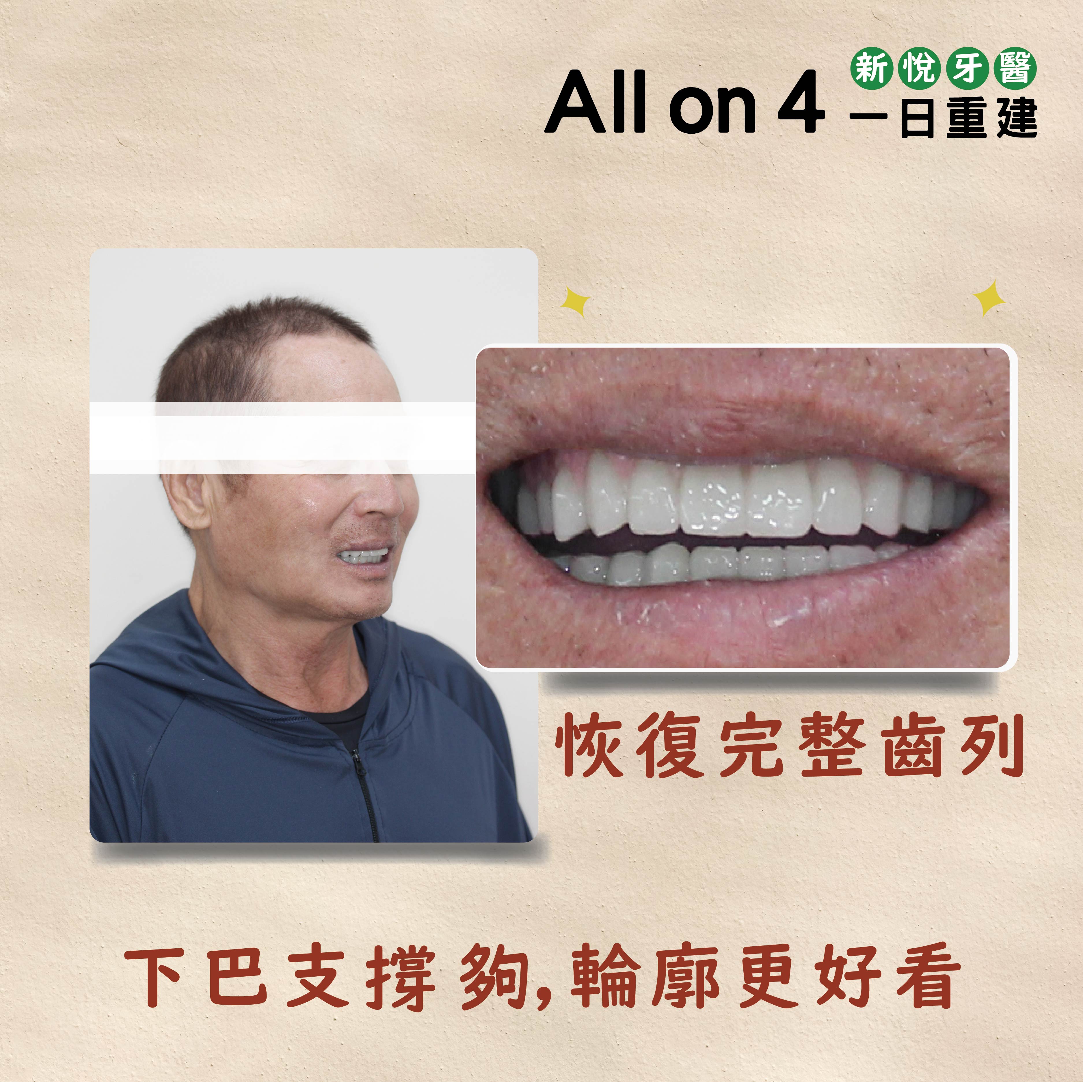 All on 4 全口重建植牙兩大專科名醫聯手接力的第8張圖片
