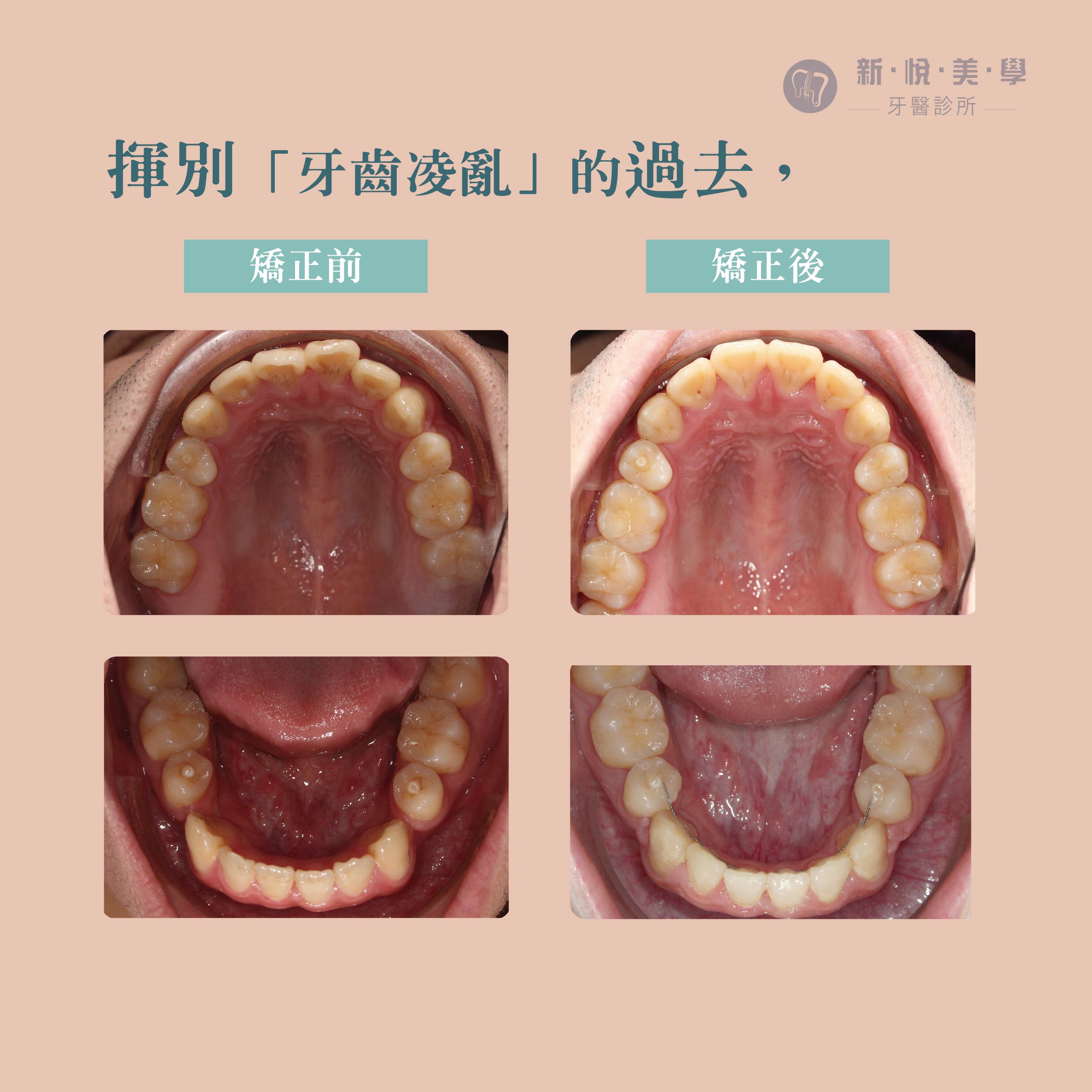 戽斗不再是困擾！非手術矯正的第2張圖片