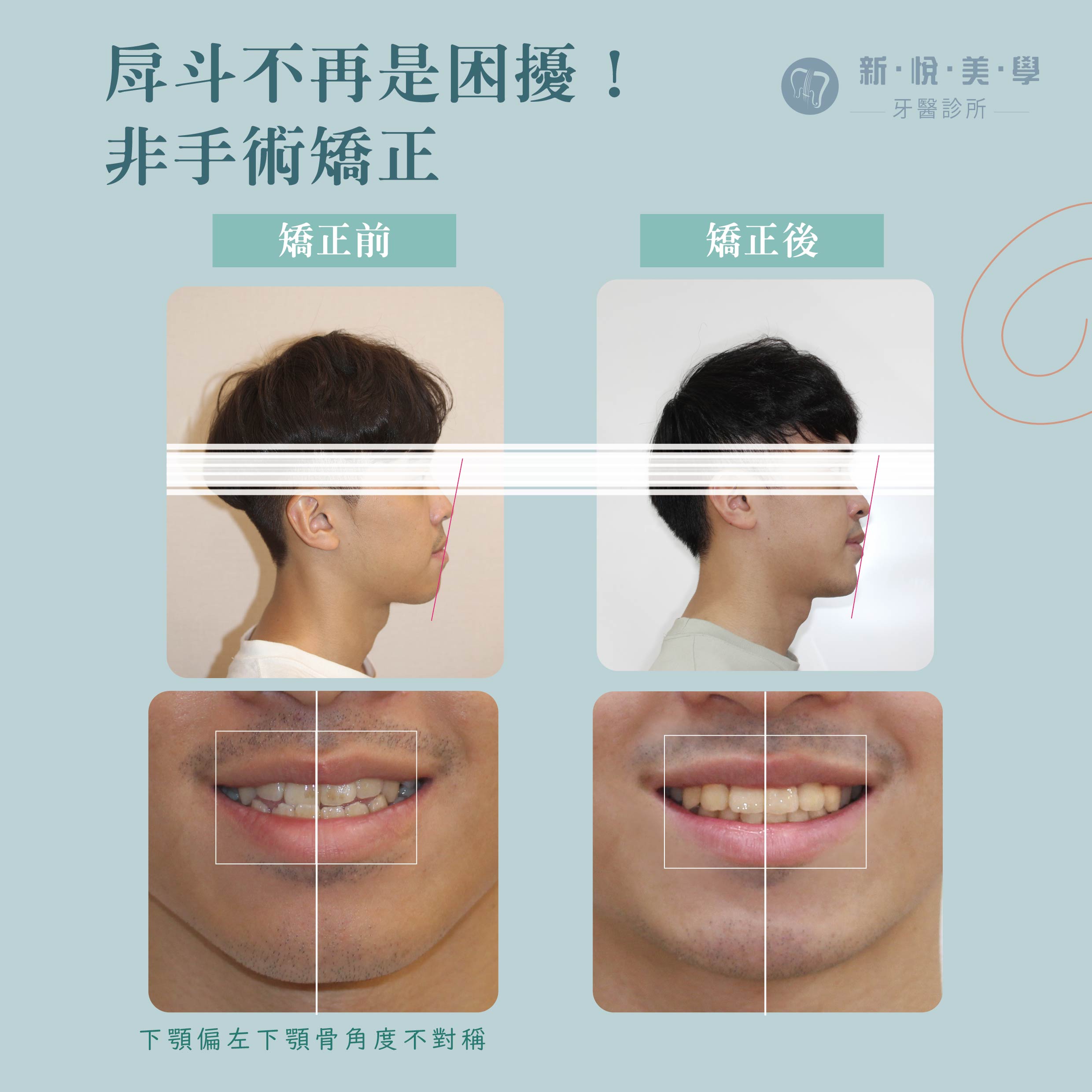 戽斗不再是困擾！非手術矯正的第3張圖片