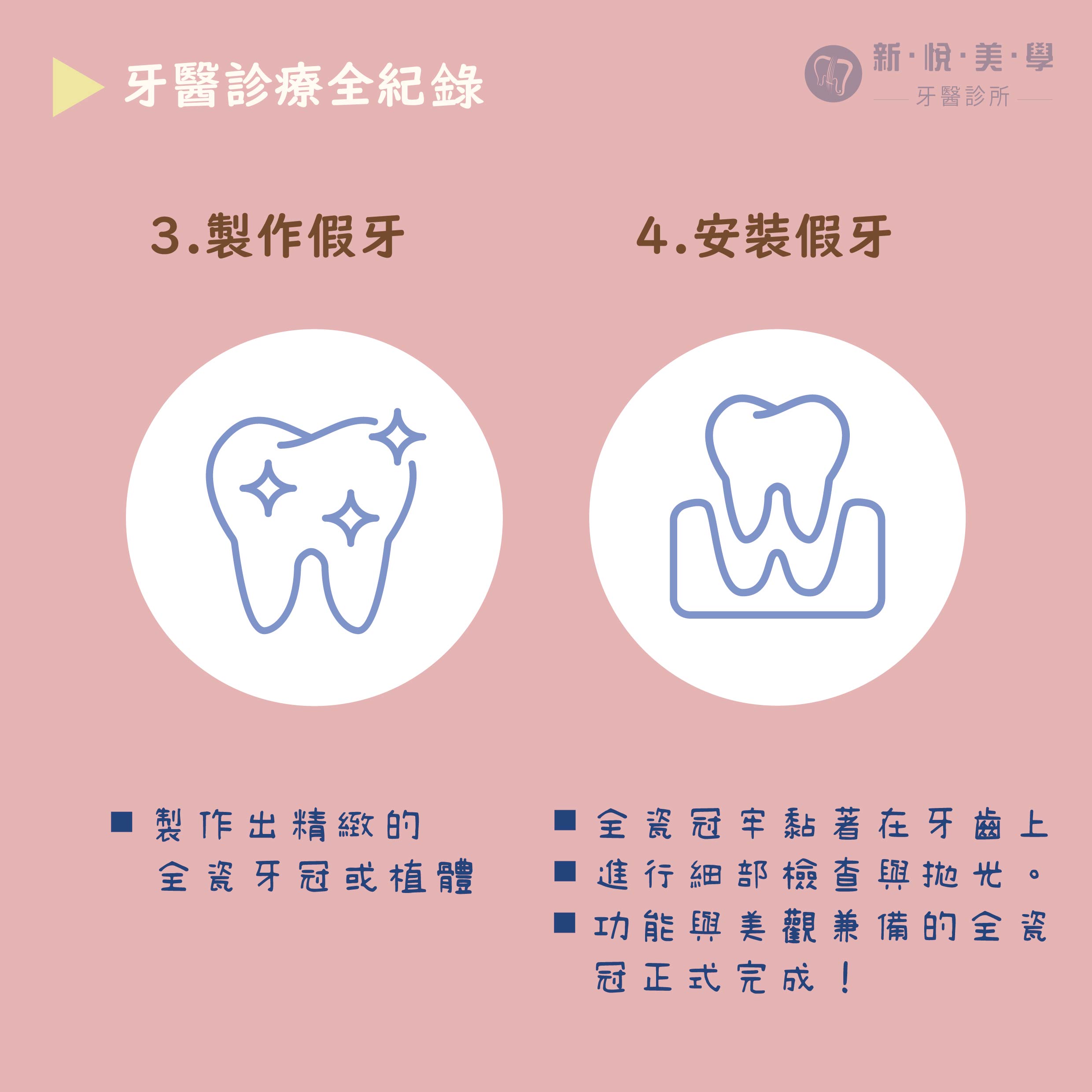 一顆全瓷冠的誕生全紀錄的第3張圖片