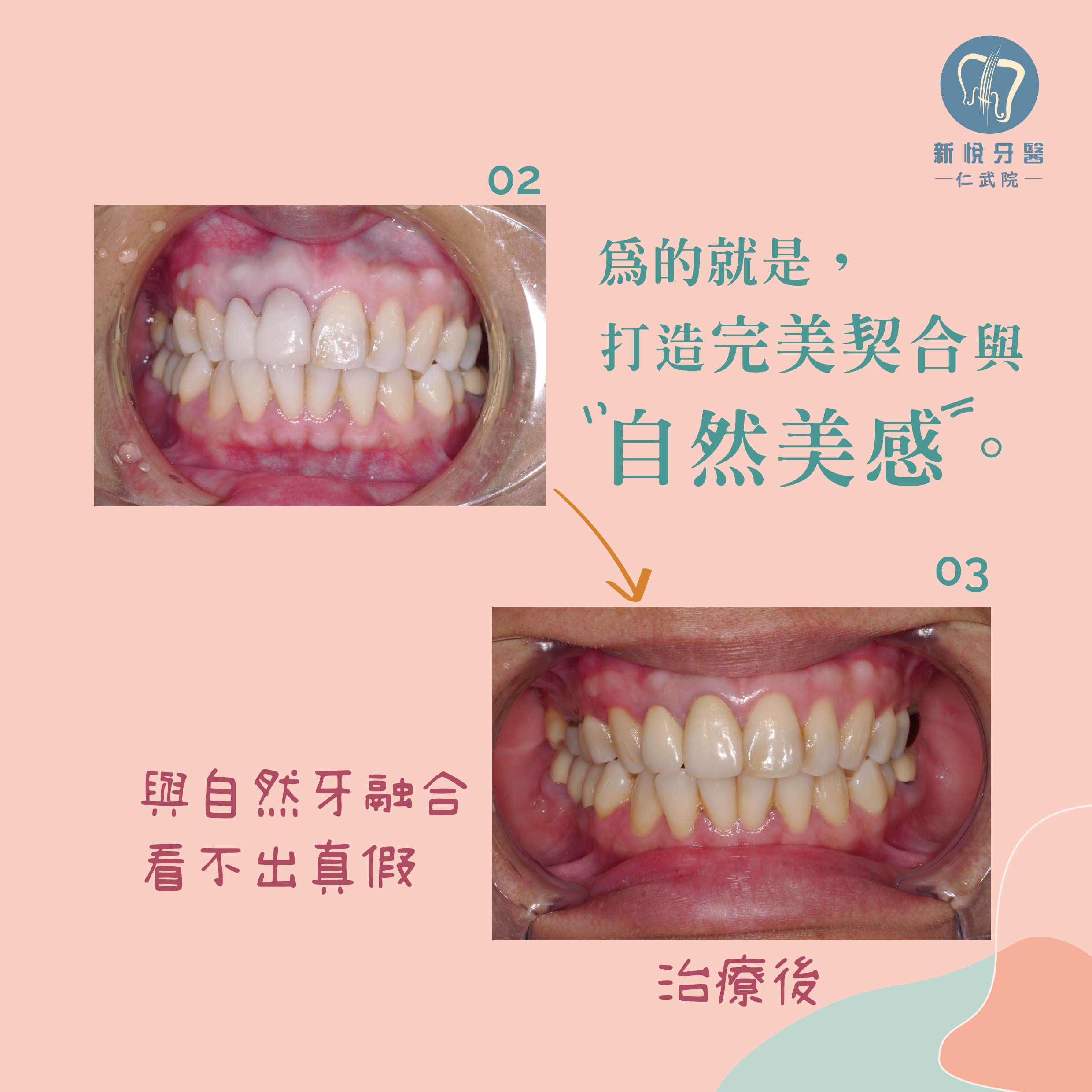 每一步都是精雕細琢~全瓷冠的第2張圖片