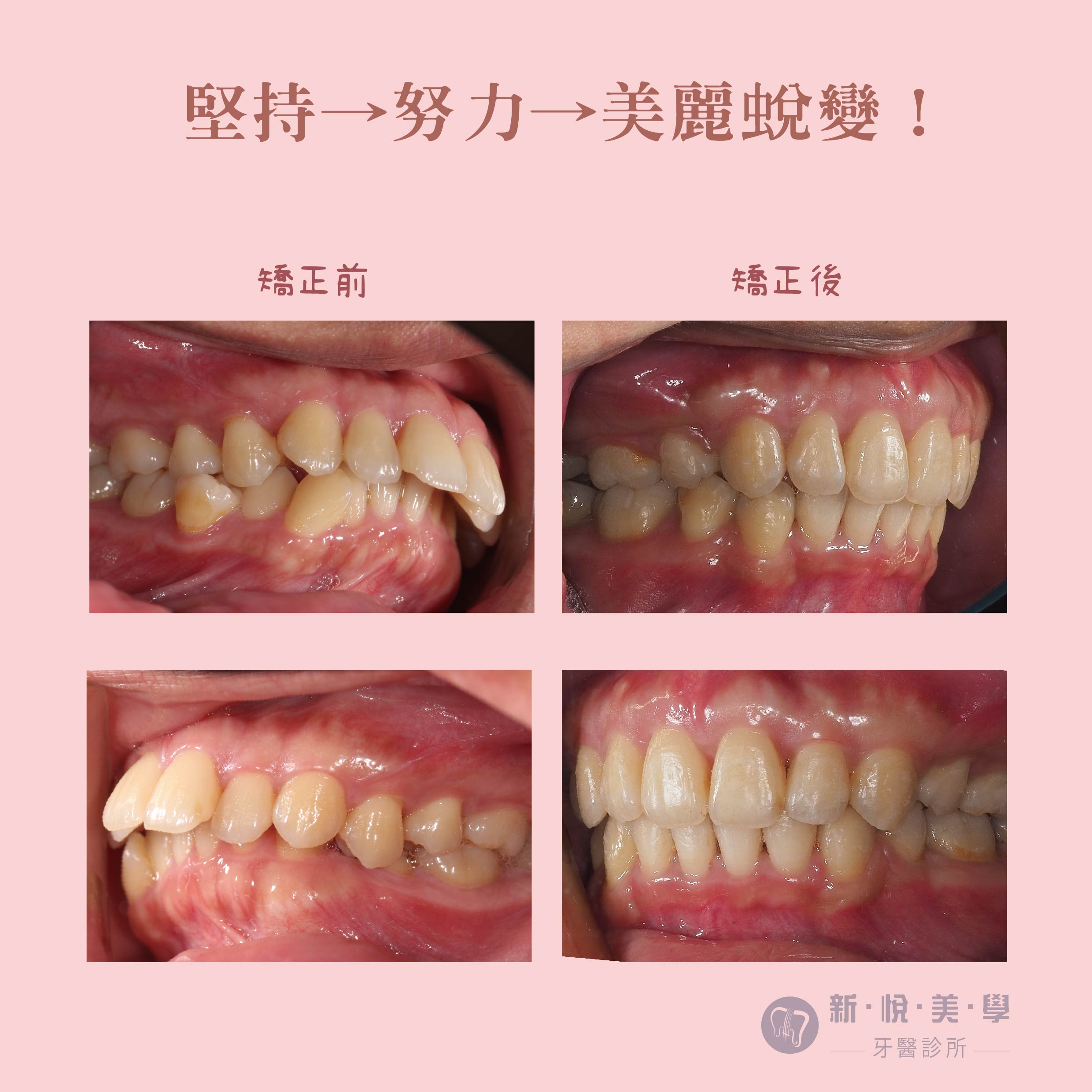 極難矯正案例｜從齒開始！ 的第2張圖片