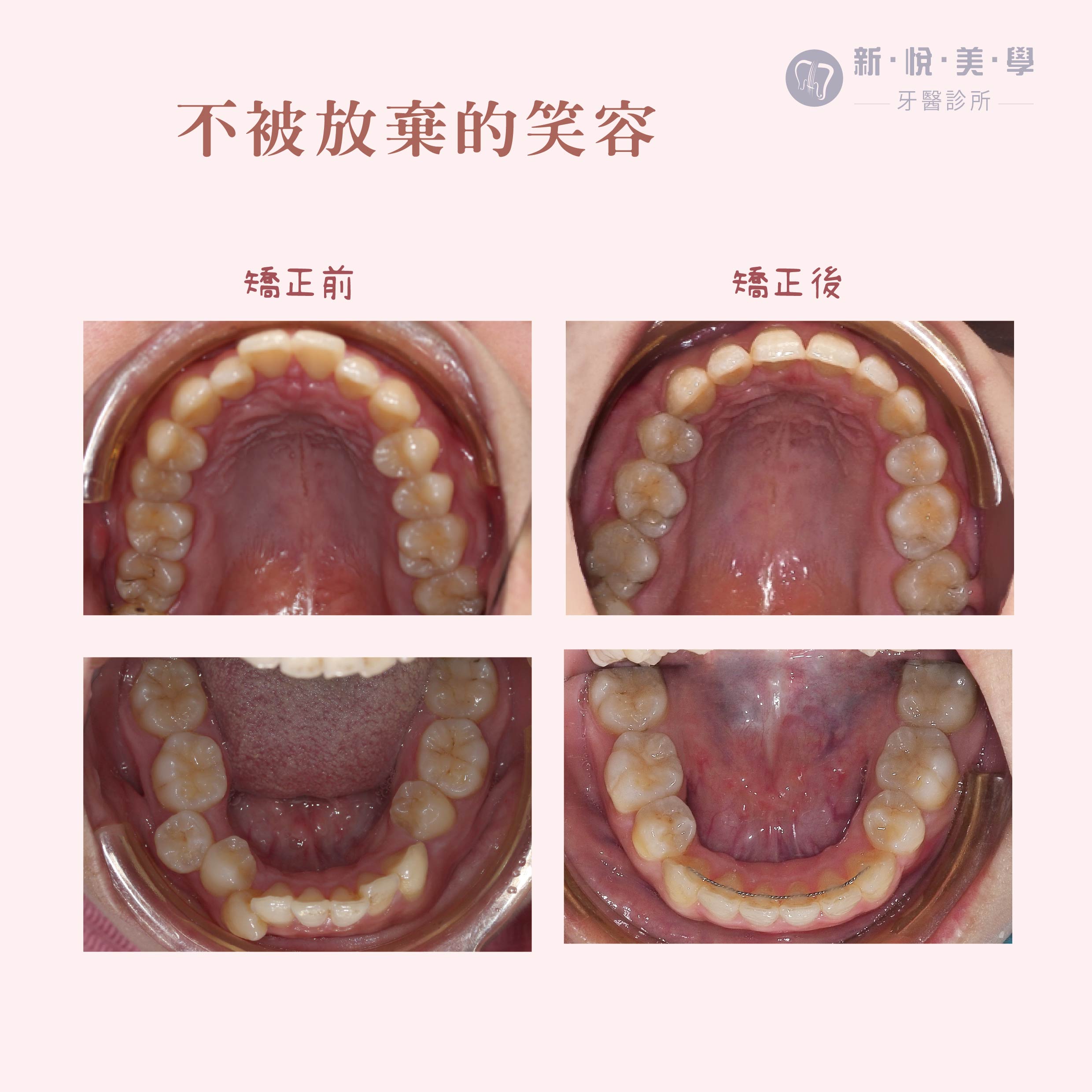 極難矯正案例｜從齒開始！ 的第3張圖片