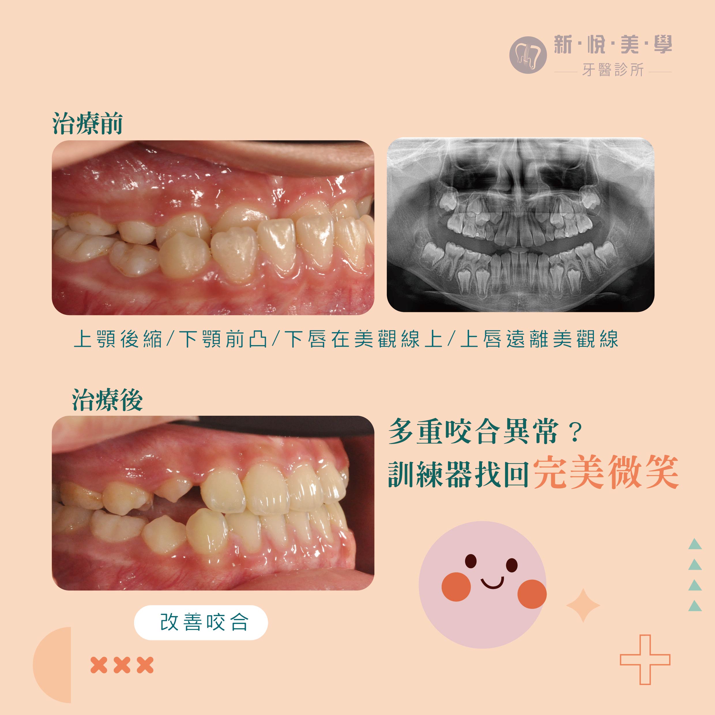 新悅美學牙醫-從小改善齒列，給孩子自信的未來！的第3張圖片